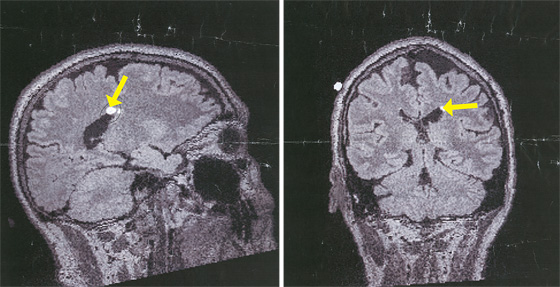 Baker's Brain Highlighted at left is an abnormality that proved benign (the brain disease he did not have); at right, the caudate nuclei, where his brain is likely to shrink first.   (Photo: Courtesy of Kevin Baker)